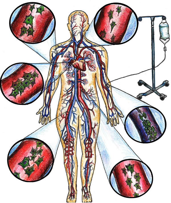 Peripheral intravenous administration of allogeneic MSCs via systemic circulation.