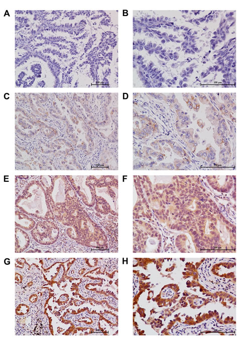 Immunohistochemical stainings of plakoglobin in the primary tumor of surgically resected lung adenocarcinoma.
