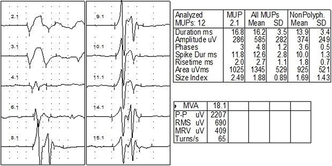 EMG of one case with right RIBP.