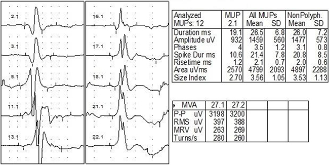 EMG of one case with bilateral RIBP.
