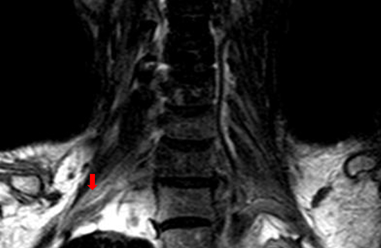 The T1-weighted coronal MRI scan of one case with unilateral RIBP.
