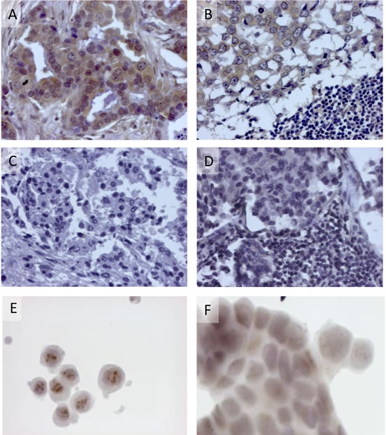 Expression of p14 in human breast cancer cells.