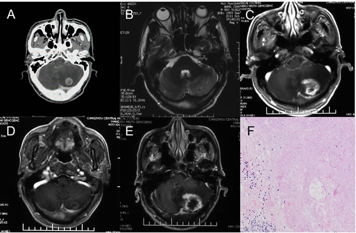 One case of brain necrosis recurrence after bevacizumab discontinuation.