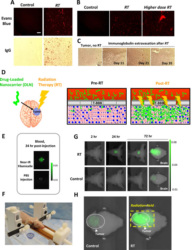 Targeted radiation therapy disrupts the Brain Tumor&#8217;s blood-brain barrier and permits greater penetration of filomicelle nanocarrier.