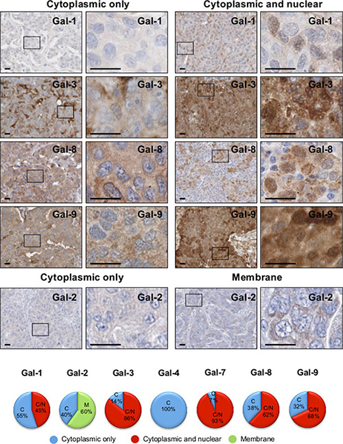Subcellular localization of galectins in breast cancer tissues.