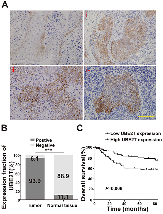 UBE2T expression in NPC patient samples by IHC.