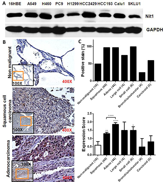 Increased Nit1 expression in human lung cancer.