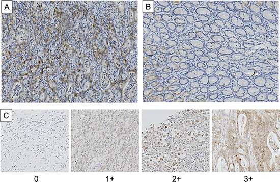 Immunohistochemical staining of HSP110 in primary gastric cancer samples.