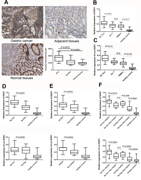Lnc-SGK1 and SGK1 expression was enhanced in human GC, especially in infiltrating T cells.