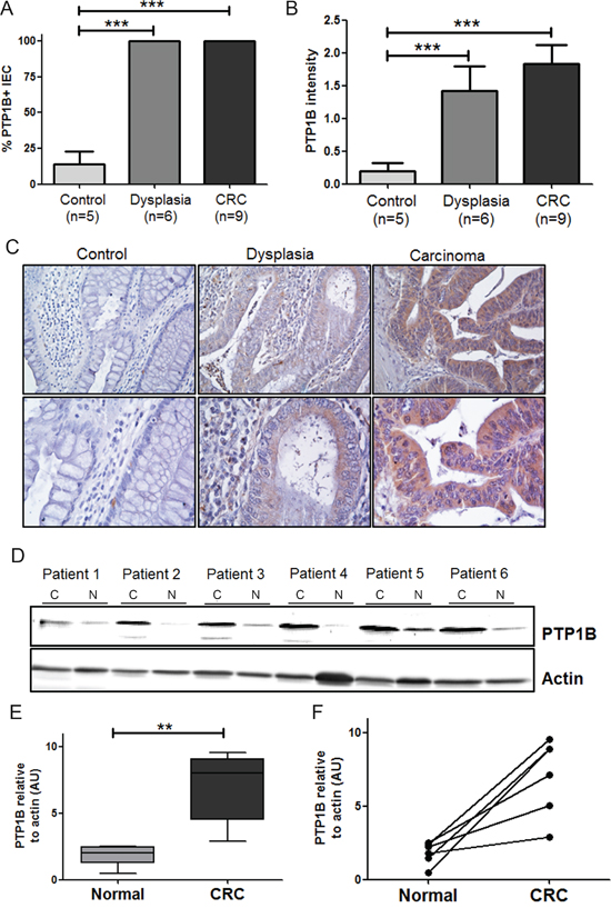 Expression levels of PTP1B are follow a stepwise increase from control, to dysplasia, to carcinoma.