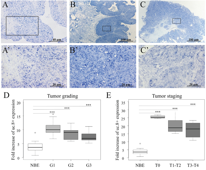 Ultraconserved RNA (uc). 8+ expression in human bladder cancer (BlCa) tissues.