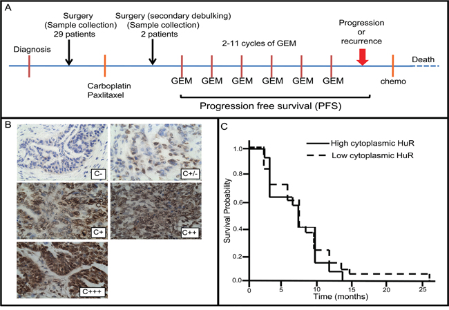 Analysis of HuR subcellular localization in ovarian tumor specimens and corresponding progression free survival of patients.