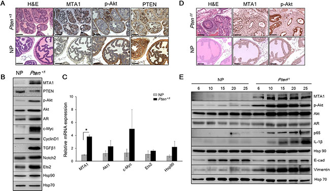 MTA1 promotes the Pten loss-driven prostate tumorigenesis and cancer progression.