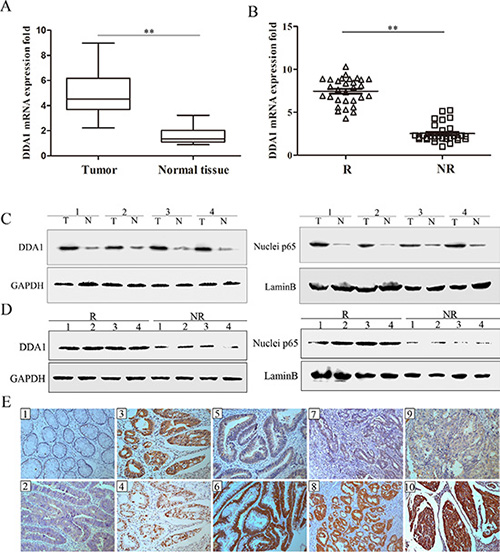 DDA1 and nuclear p65 levels in relapsed and nonrelapsed stage II colon cancer tumors.