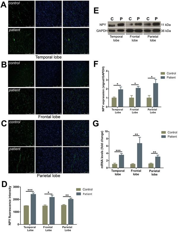 The expression of NPY was increased in different cortical lobes of FCD patients.