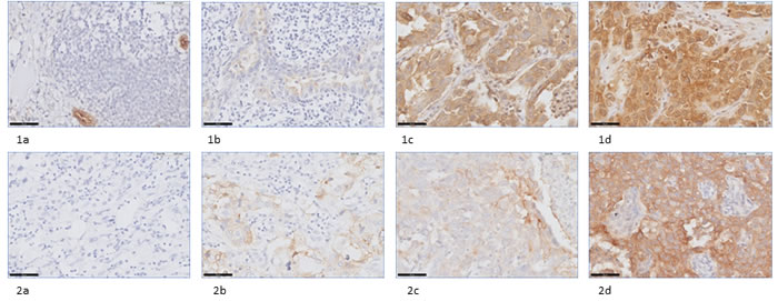 Staining intensities of FR&#x3b1; in NSCLC and breast cancer samples using immunohistochemistry (IHC).