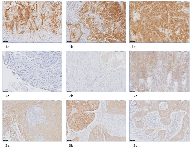 Examples of (dis)concordance in FR&#x3b1; staining in biopsy-, primary tumor-, and metastatic LN tissue in NSCLC and breast cancer patients.