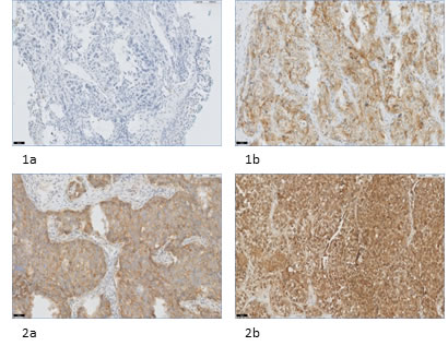 FR&#x3b1; expression in NSCLC and corresponding distant metastases.