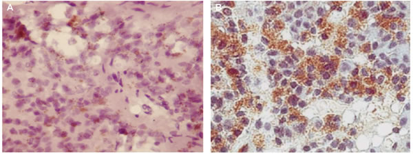 CD5 expression evaluated by immunohistochemistry (200x) in the pineal gland (A) and thymus (B) of elderly people.