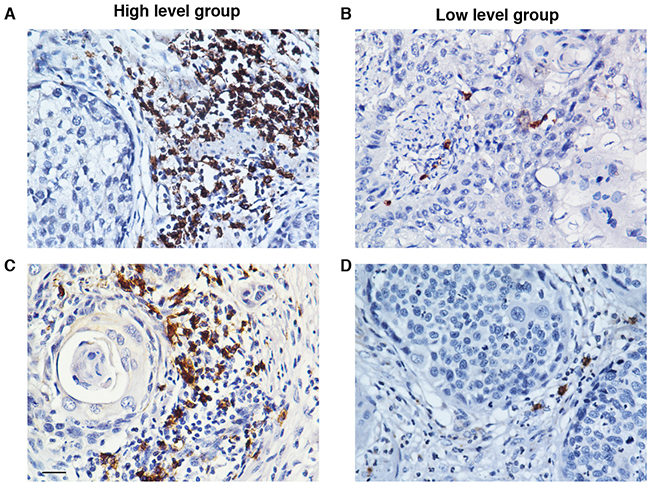 The accumulation of CD20+ B cells in the tumor nests of ESCC patients.