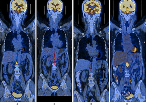 Positron emission computer tomography images demonstrate lymphadenopathy post-crura of the right diaphragm from a relapsed diffuse large B-cell lymphoma patient.
