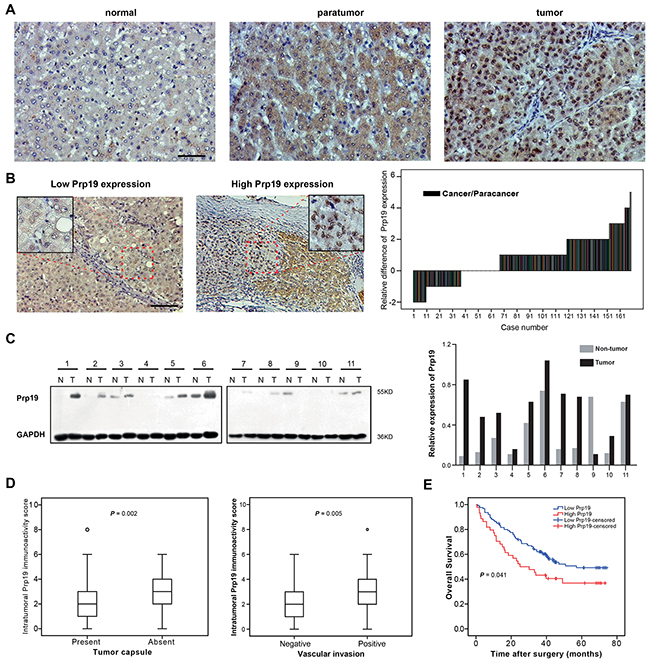 Prp19 overexpression in HCC indicates invasiveness and poor prognosis of HCC.