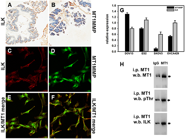 Expression of ILK and MT1-MMP in human ovarian carcinoma tissues and cells.