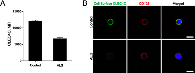 Reduced surface CLEC4C in the PDC of the ALS patient.