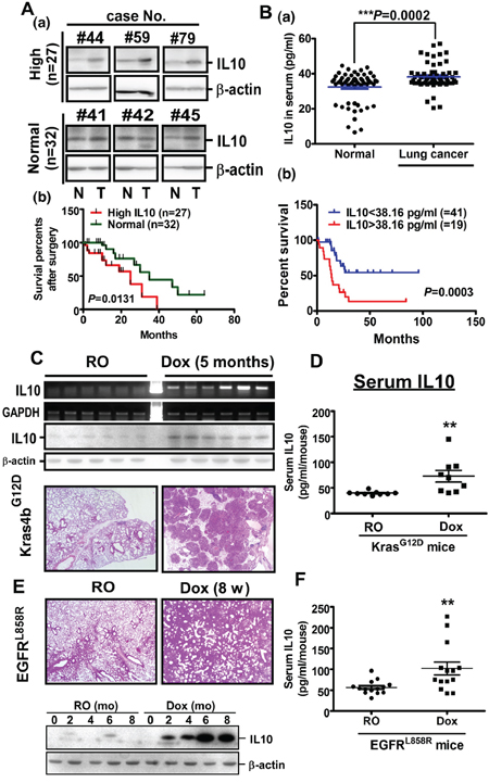 IL10 is over expressed in lung cancer.