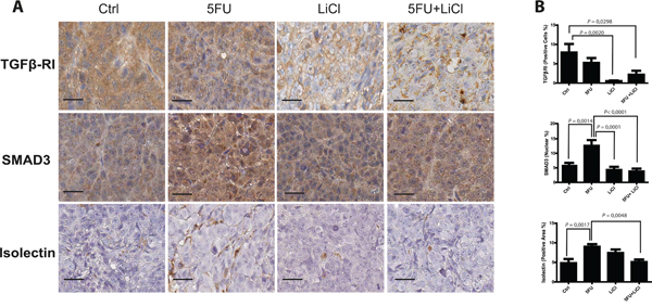 5-fluorouracil treatment causes an activation of TGF-&#x03B2; pathway in xenografted chemoresistant cells.