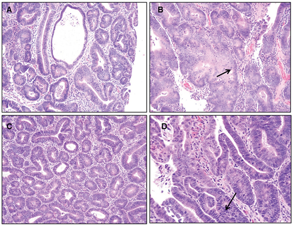 Representative figures of H&#x0026;E staining of colon of PIRC rats (200x magnification) following: