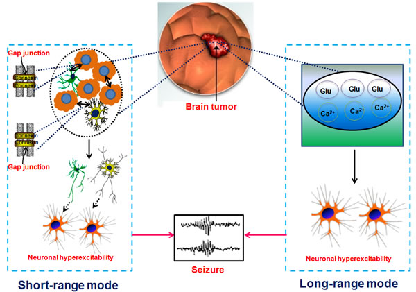 Proposed long-range mode and short-range mode in tumor associated epilepsy.