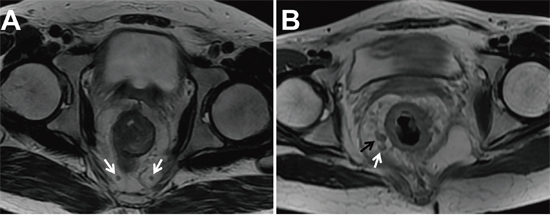 Two T2-weighted axial images in different patients with low rectal cancers.
