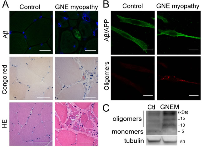 Intracellular A&#x3b2; aggregates in GNE myopathy.