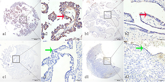 EphA8 protein was detected in ovarian cancer tissues but not in normal fallopian tube and normal ovarian tissues.