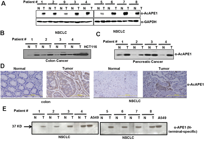 Elevated levels of AcAPE1 in tumor tissue.