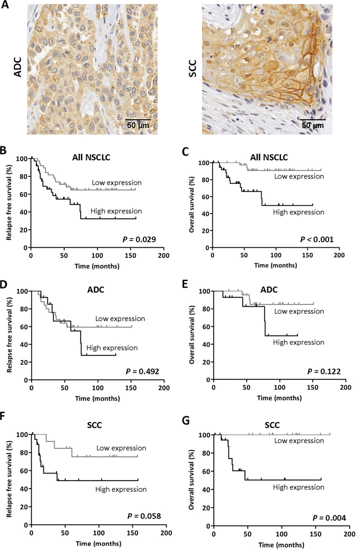 High TMPRSS4 protein expression correlates with poor prognosis.