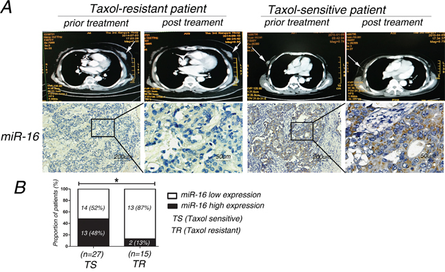 The expression level of miR-16 in Taxol-sensitive breast cancer tissues is higher than that in Taxol-resistant tissues.