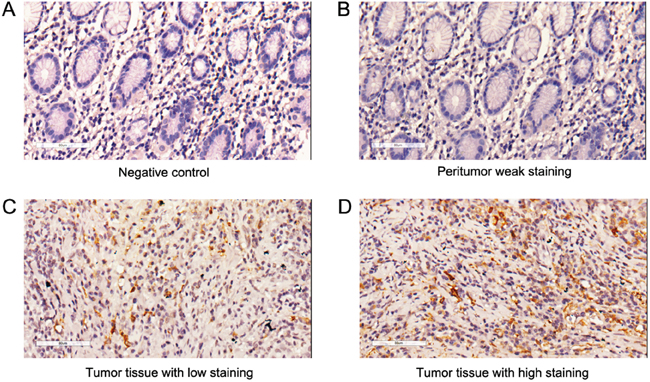 CCR2 expression in gastric cancer tissues and peritumoral tissues.