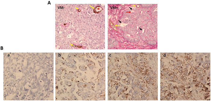 VM and uPA expression in ovarian cancer tissues.