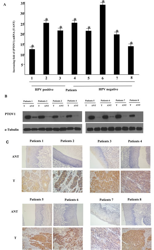 Overexpression of PTOV1 mRNA and protein in human laryngeal squamous cell carcinoma (LSCC) tissues.