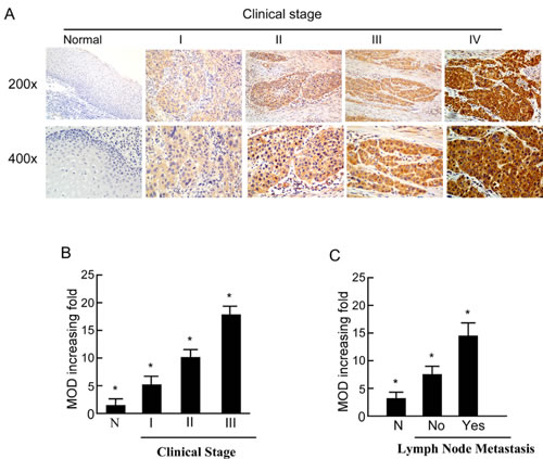Expression of PTOV1 in different clinical stages of laryngeal squamous cell carcinoma (LSCC).