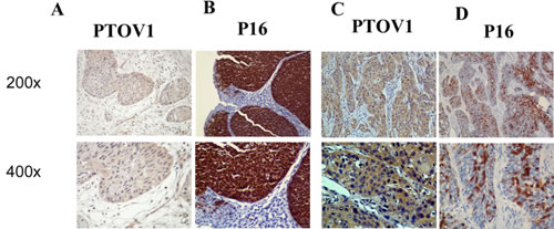 Same region of same tumor staining positive for PTOV1 (A, C; 200&times;, 400&times;) and p16 (B, D; 200&times;, 400&times;).