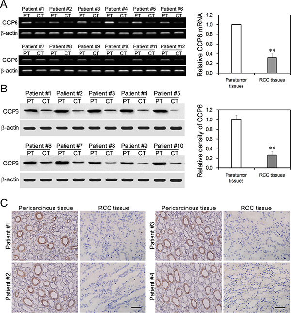 Downregulated CCP6 expression in RCC tissues.