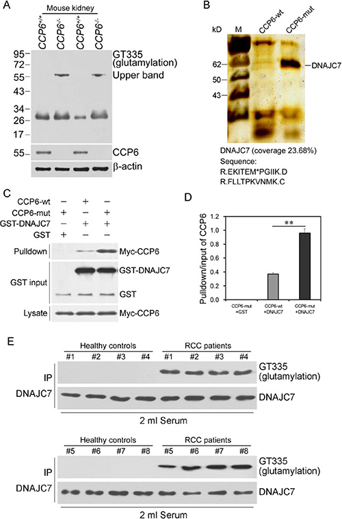 Glutamylated GST-DNAJC7 protein binding to CCP6 protein in RCC tissues and sera.