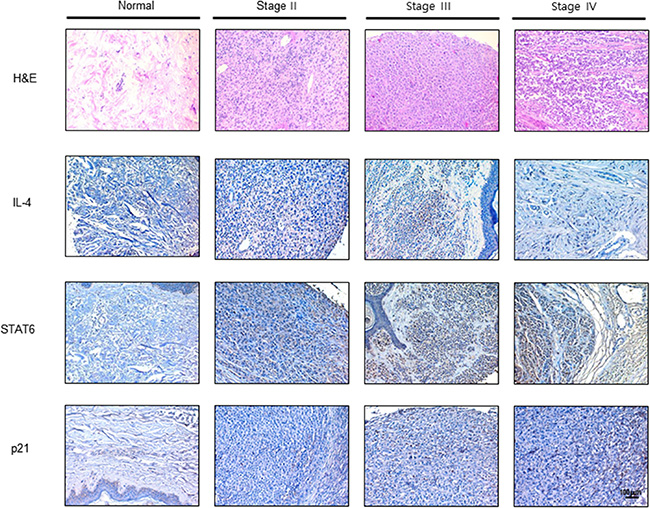 Expression of IL-4, STAT6 and p21 in human melanoma patients.