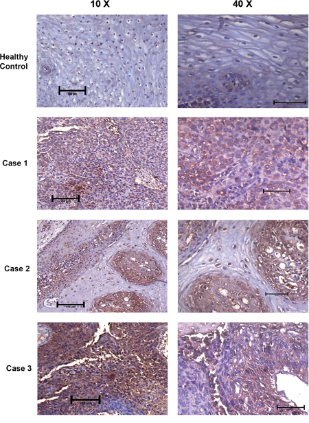 DEPTOR is overexpressed in human cervical squamous cell carcinoma tissues.