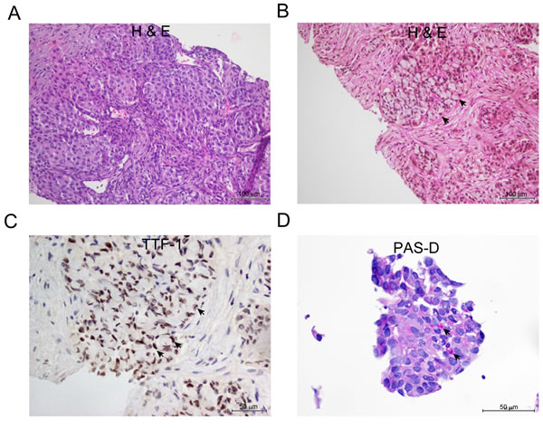 Representative appearance of NSCLC adenocarcinoma with signet ring cells features.