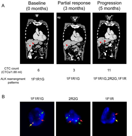 An index case suggests that ALK-rearranged CTCs could have clinical application as a diagnostic biomarker to monitor crizotinib treatment and response.