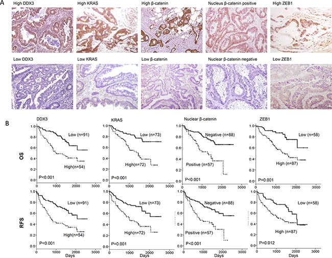 The representative immunostaining results of DDX3, KRAS, &#x03B2;-catenin expression in nucleus/cytoplasm, and nuclear &#x03B2;-catenin in colorectal tumors and the prognostic value of these molecules on OS and RFS was assessed using a Kaplan-Meier analysis.